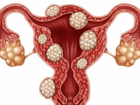 Đa nhân xơ tử cung là gì? Dấu hiệu, nguyên nhân và cách điều trị hiệu quả